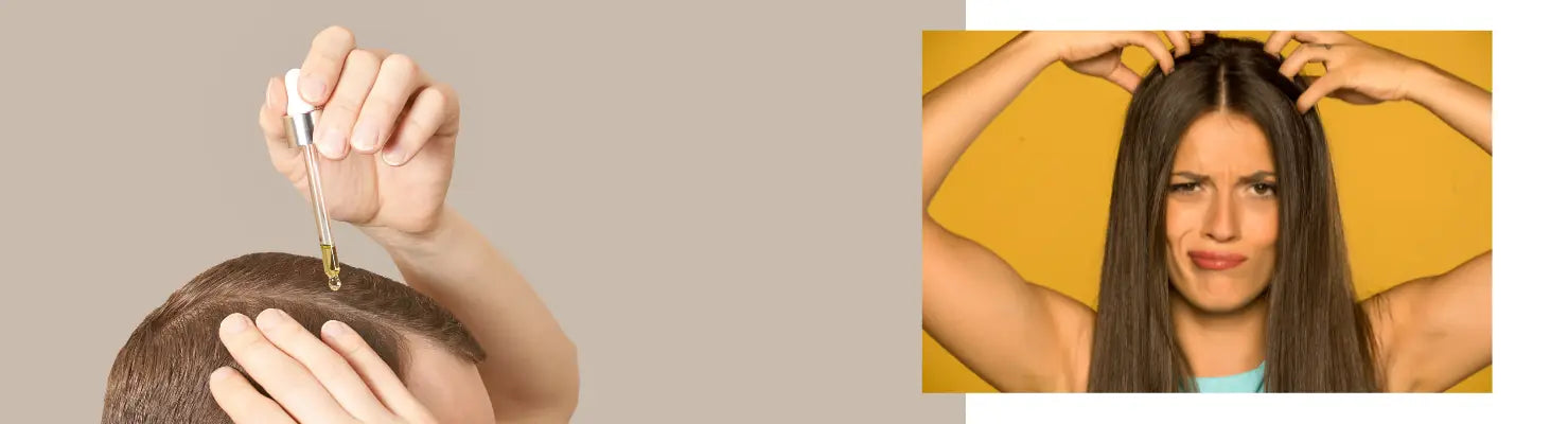 Hair oil Anwendung bei juckender Kopfhaut, Teil der Kopfhaut Sammlung
